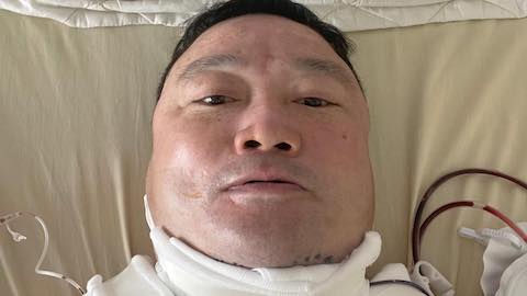 HLV Trương Việt Hoàng phẫu thuật bướu mỡ thành công